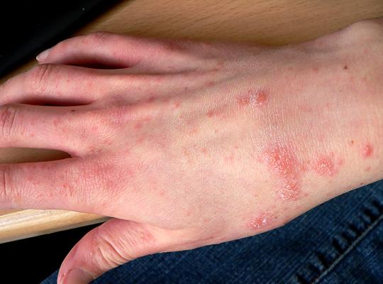 Niežai: priežastys, simptomai, gydymas ir prevencija